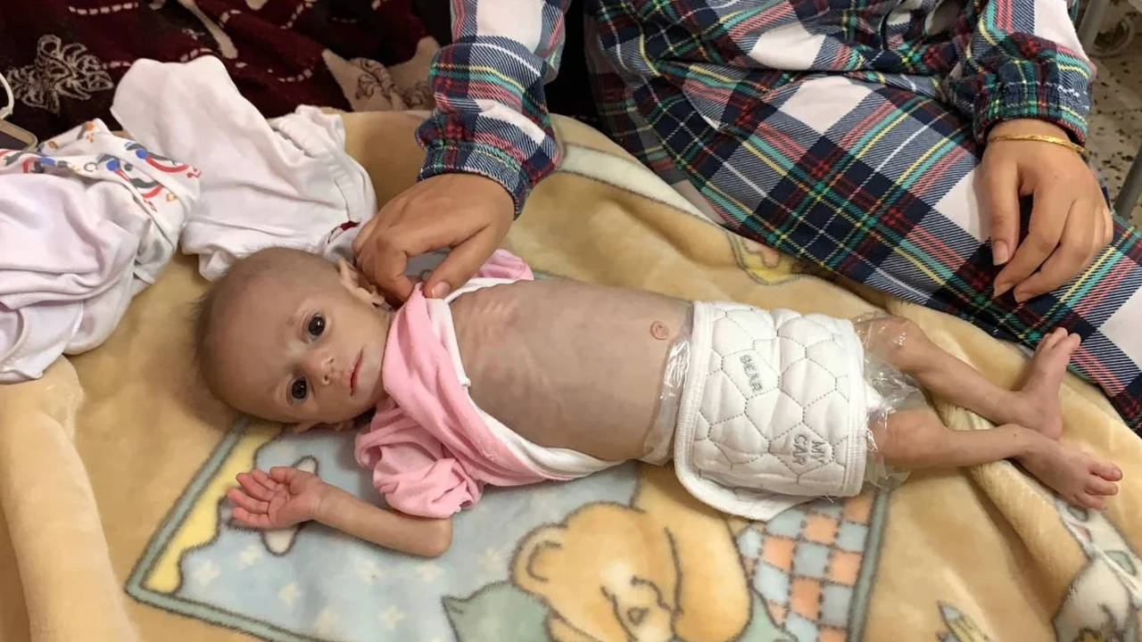 Gazzeli bebekler derinleşen İsrail ablukası altında açlıkla savaşıyor Gazzeli bebekler derinleşen İsrail ablukası altında açlıkla savaşıyor